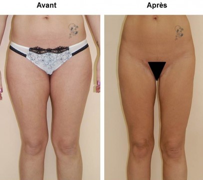 resultat-lifting-des-cuisses-photo-avant-apres