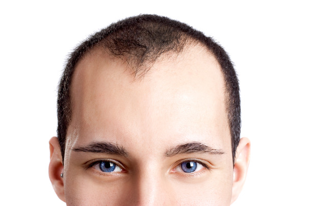 implant-capillaire-tunisie