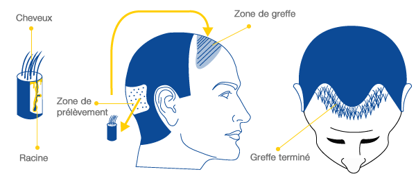 technique-greffe-cheveux-fue