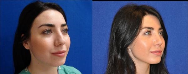la rhinoplastie tunisie
