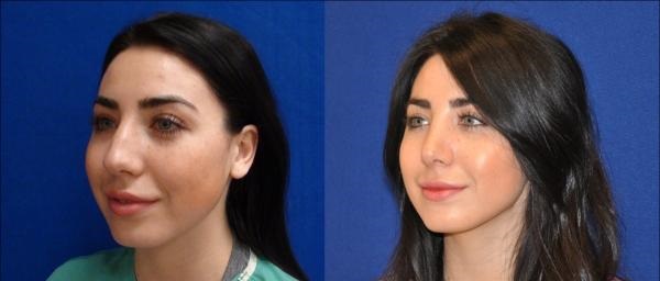 rhinoplastie en tunisie