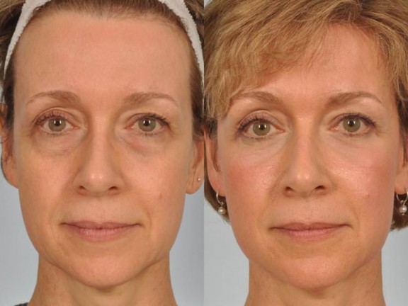 Le masque pour la personne enlever les traces des boutons
