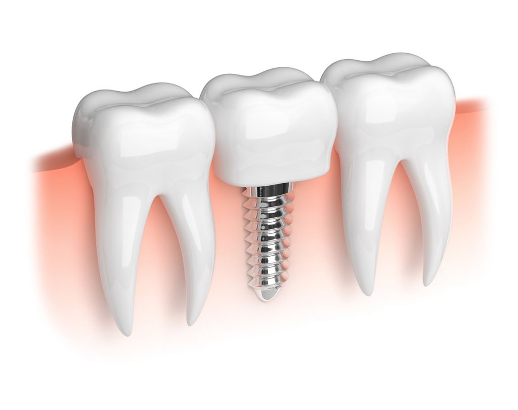 implants dentaires en Tunisie
