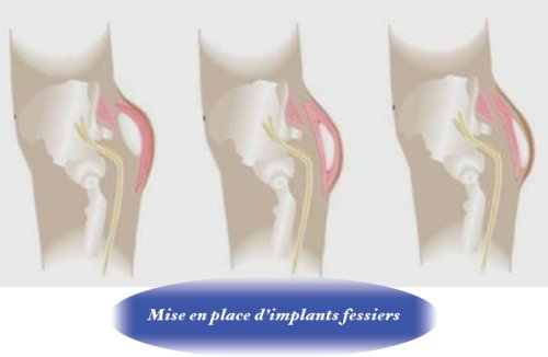 augmentation des fesses par implants