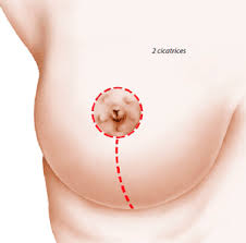 La mammoplastie par implantation de prothèses mammaires
