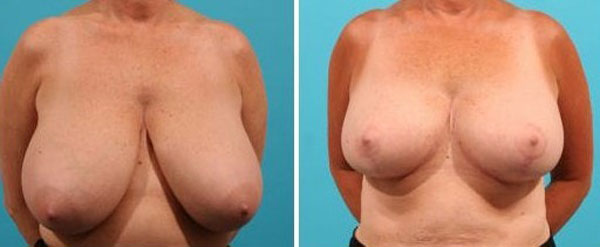  Quelles sont les suites opératoires d’un lifting des seins ?