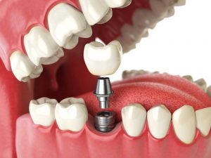 Les implants dentaires en Tunisie