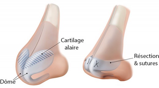 Rhinoplastie de la pointe tombant