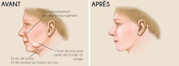 lifting du visage