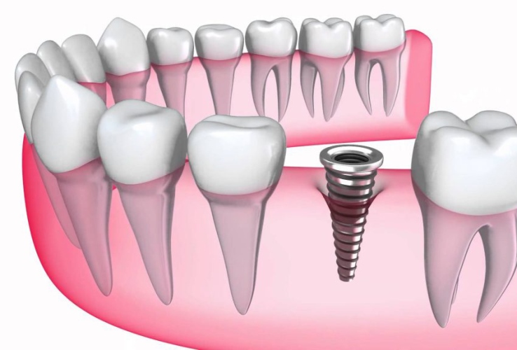 implants en Tunisie