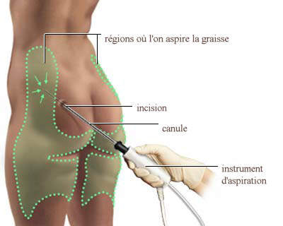 Incisions-des-fesses-aspiration-de-graisse