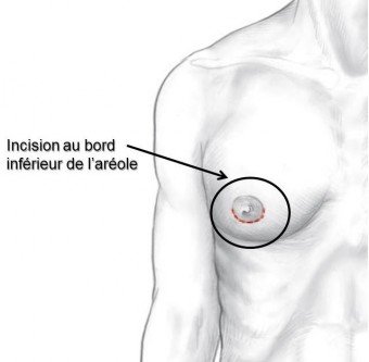 zone-incisions-gynecomastie-homme