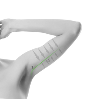 LIFTING DES BRAS LONGITUDINAL 1. Cicatrice le long du bras 2. Lipoaspiration et remise en tension le long du bras