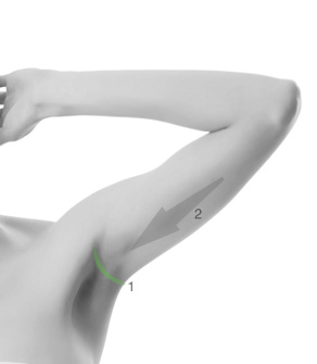 LIFTING BRACHIAL AXILLAIRE 1. Cicatrice dans l’aisselle 2. Lipoaspiration et remise en tension modérée