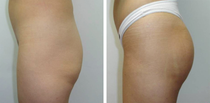 lipofilling-fesses-photo-avant-apres
