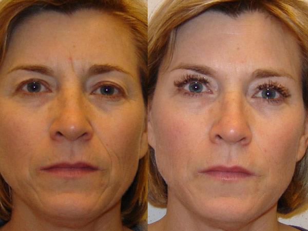 lipofilling-visage-photo-avant-apres