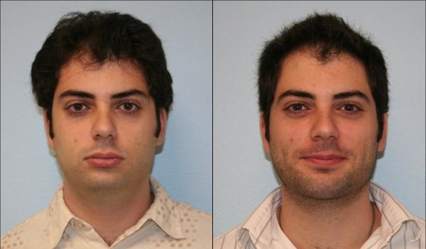 resultat-chirurgie-menton-tunisie