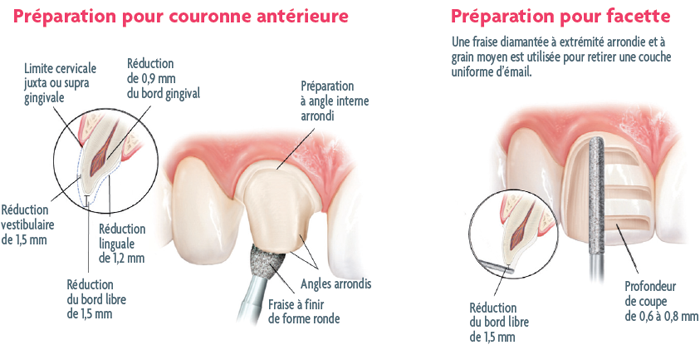couronne-facette-dentaire