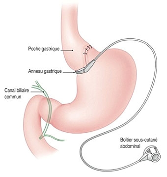 L’ anneau gastrique est un traitement efficace contre l’obésité