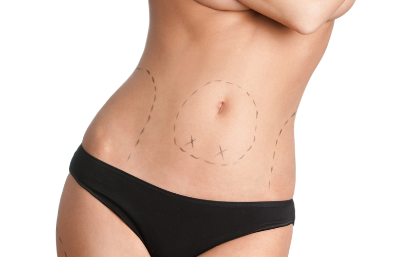 Opération ventre plat : abdominoplastie serait-elle la solution ?