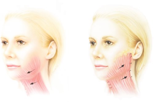 Lifting du cou : rajeunissement du bas du visage