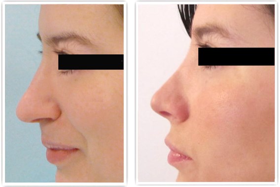 Un nez remodelé grâce à la rhinoplastie!