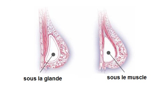 Prothèses mammaires sous le muscle : Indications