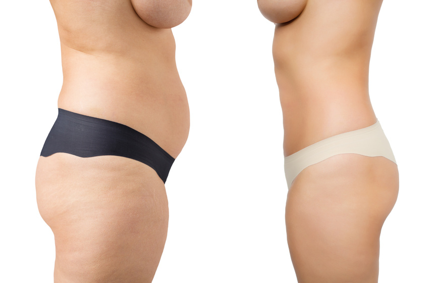 Que choisir : Sport ou Abdominoplastie ?