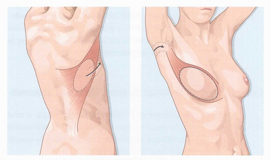 Un vue d’ensemble sur la reconstruction mammaire après atteinte du cancer des seins