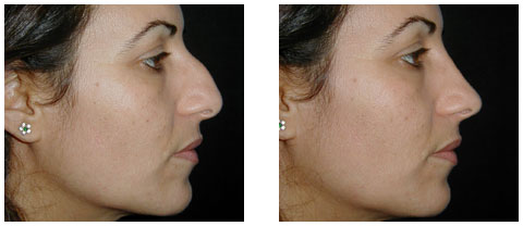 Zoom sur la chirurgie du nez : La rhinoplastie