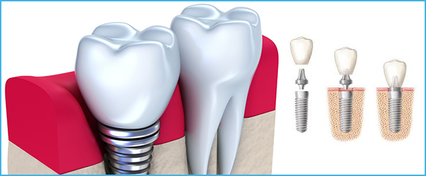 Combien coûte un implant dentaire en Tunisie ?