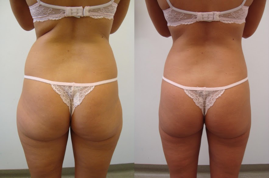 Lipoaspiration Tunisie