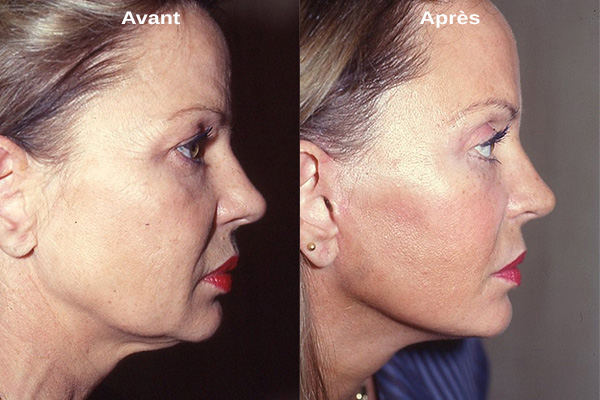 Le lifting cervico-facial