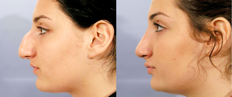 Rhinoplastie