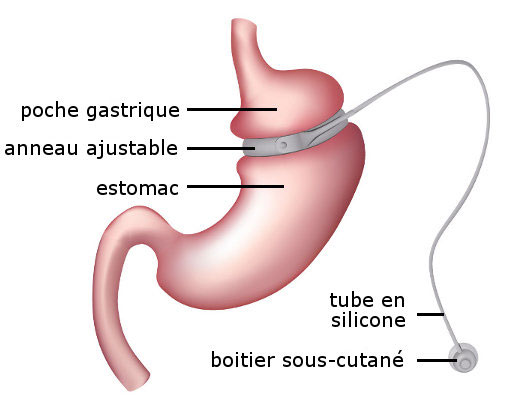 Bypass gastrique : Découvrez les avantages de la chirurgie de l’obésité !