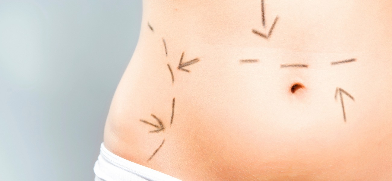 Liposuccion du ventre : Débarrassez-vous facilement de la graisse abdominale