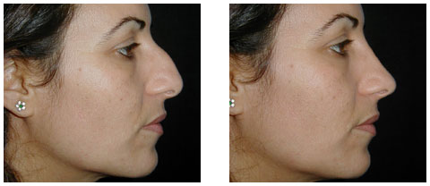 Rhinoplastie Tunisie : Qu’est-ce qu’une rhinoplastie implique ?