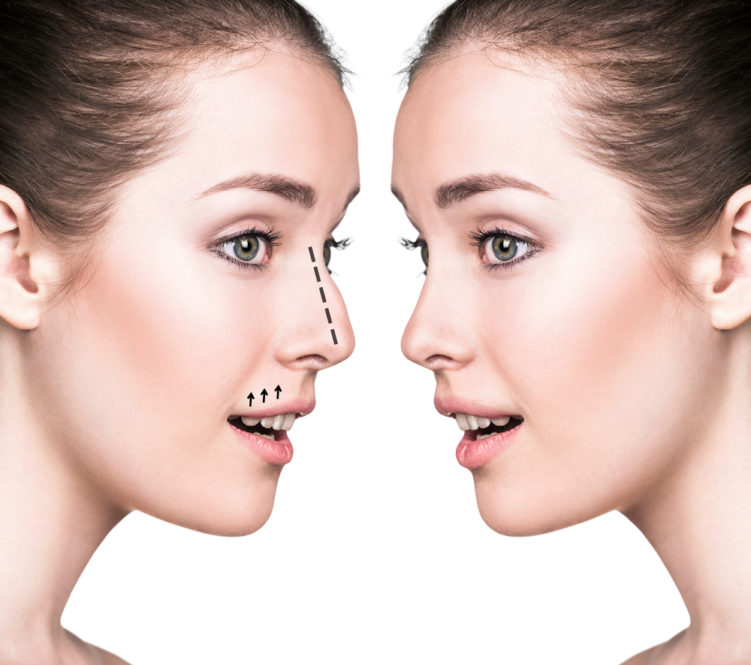 La rhinoplastie de la pointe du nez : modifications et spécificités
