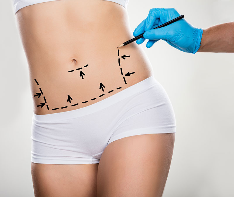 L’abdominoplastie : l’Anesthésie,Durer de l’Intervention , et Après l’intervention