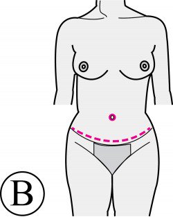 abdominoplastie-bas-abdomen-autour-nombril