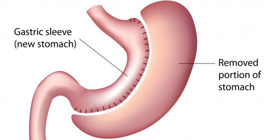 sleeve gastrique tunisie