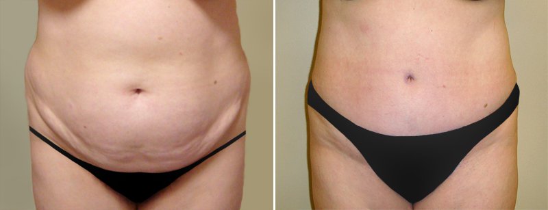 abdominoplastie-photo-avant-apres