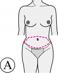 abdominoplastie-et-liposuccion
