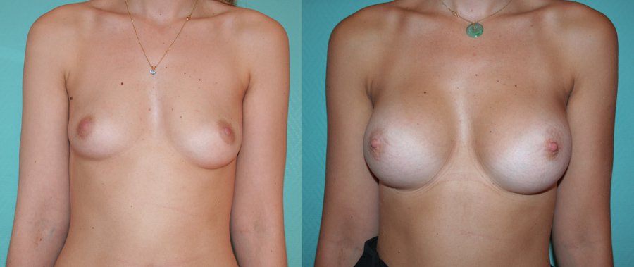 pose implant mammaire tunisie