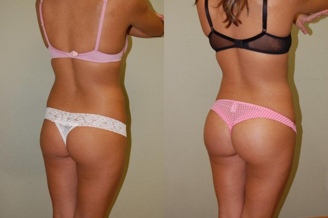 Augmentation fesses Tunisie