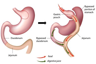 bypass gastrique tunisie