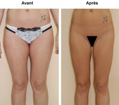 resultat-lifting-des-cuisses-photo-avant-apres