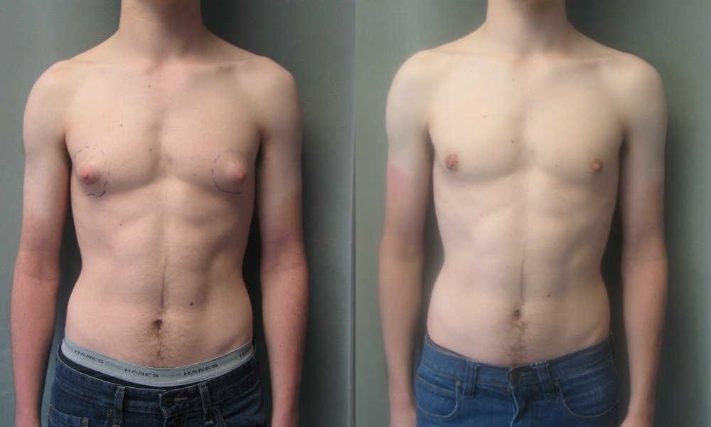 resultat-gynecomastie-photo-avant-apres