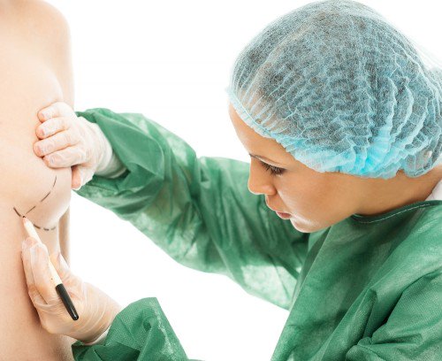 lipofilling-des-seins-incisions