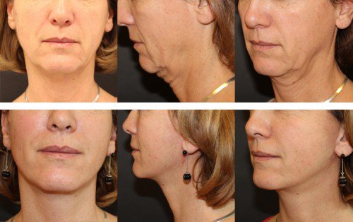 Lifting cervico facial Tunisie